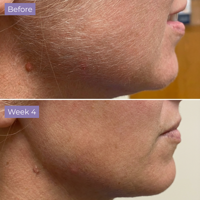 Velura Anti-Hair Skin Serum