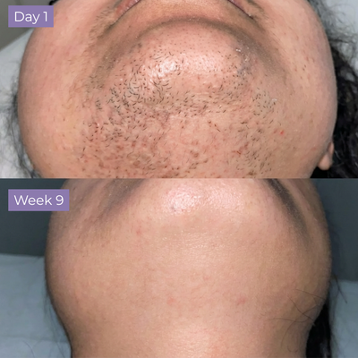 Velura Anti-Hair Skin Serum