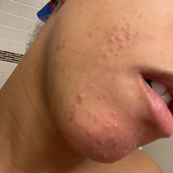 Depilatory cream irritation