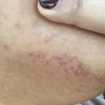 Laser irritation