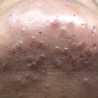 Electrolysis irritation